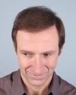 After Hair Transplant&nbsp;Front